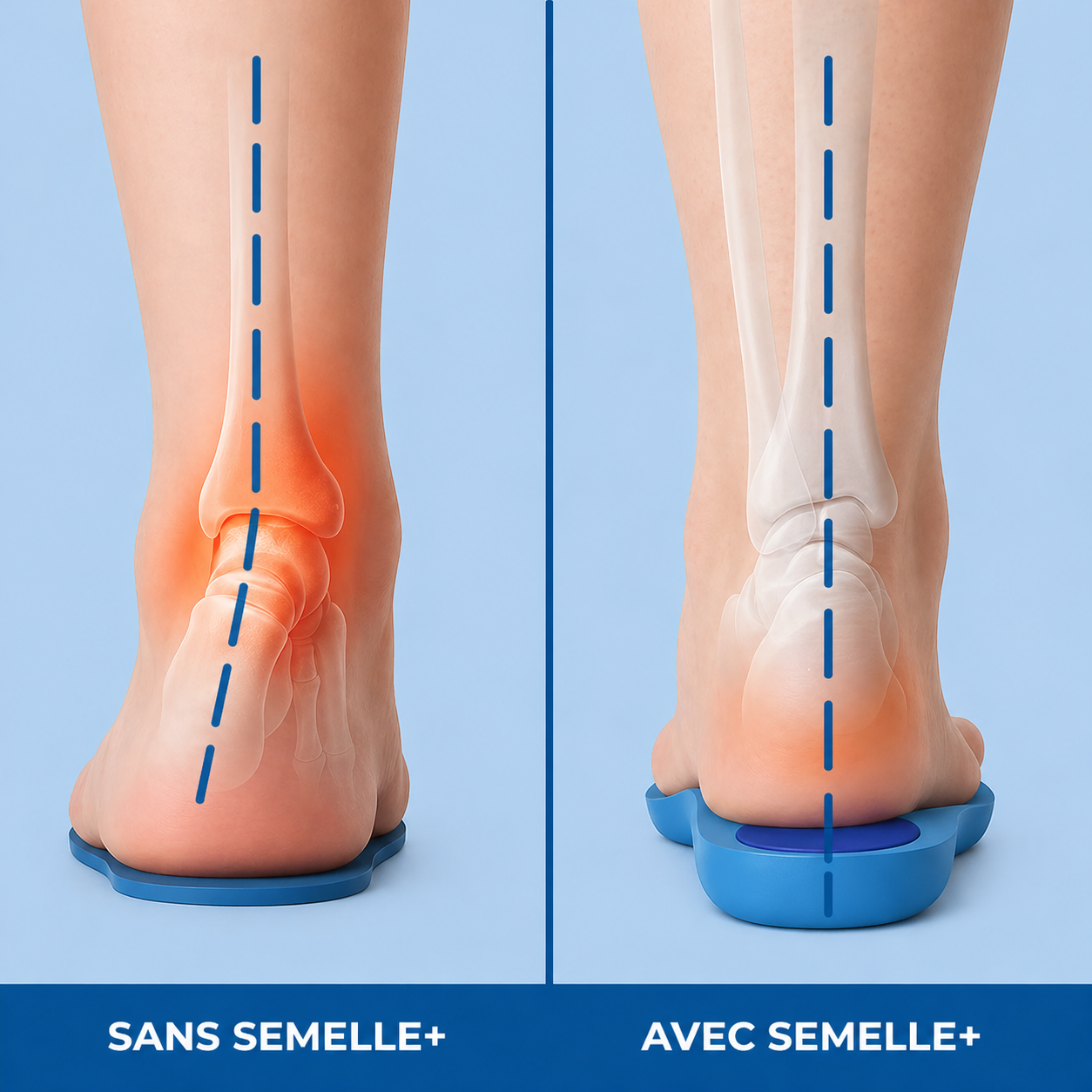 Semelles Orthopédiques Anti-Douleur
